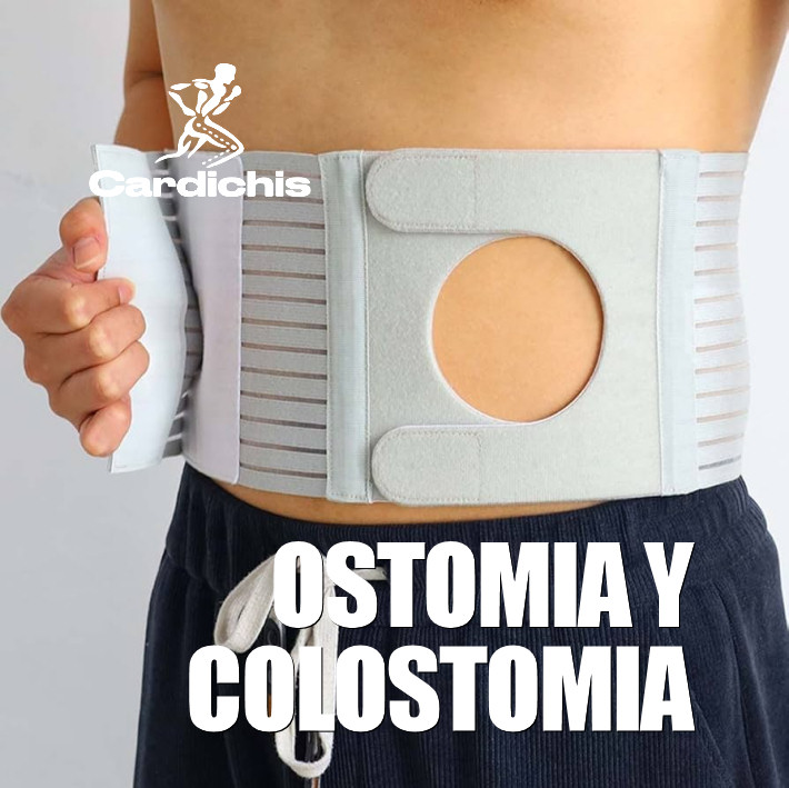 Ostomia y Colostomia